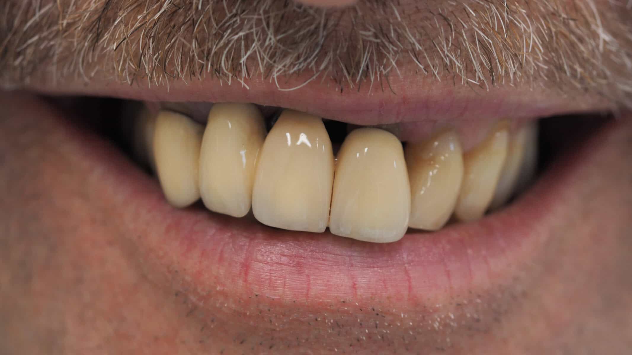 Foto vor einer Implantatbehandlung im Oberkiefer